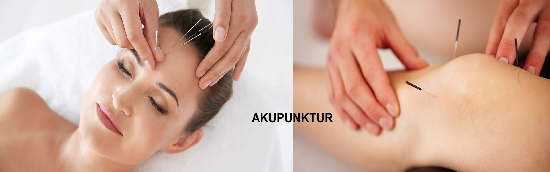 AKUPUNKTUR
